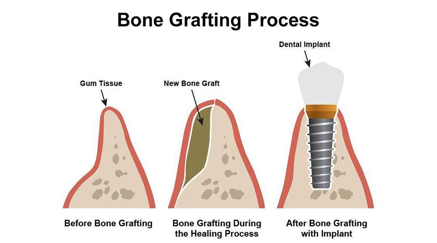 bone grafting