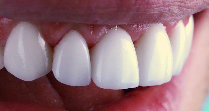 Close up of front teeth