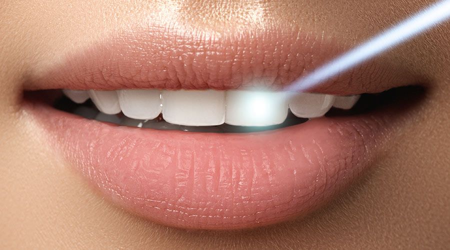 laser teeth whitening
