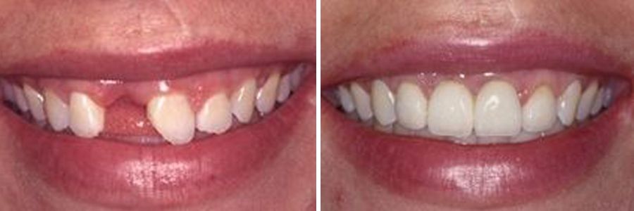 before dental implants vs after dental implants