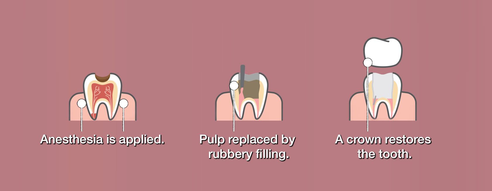 Root canal treatment process