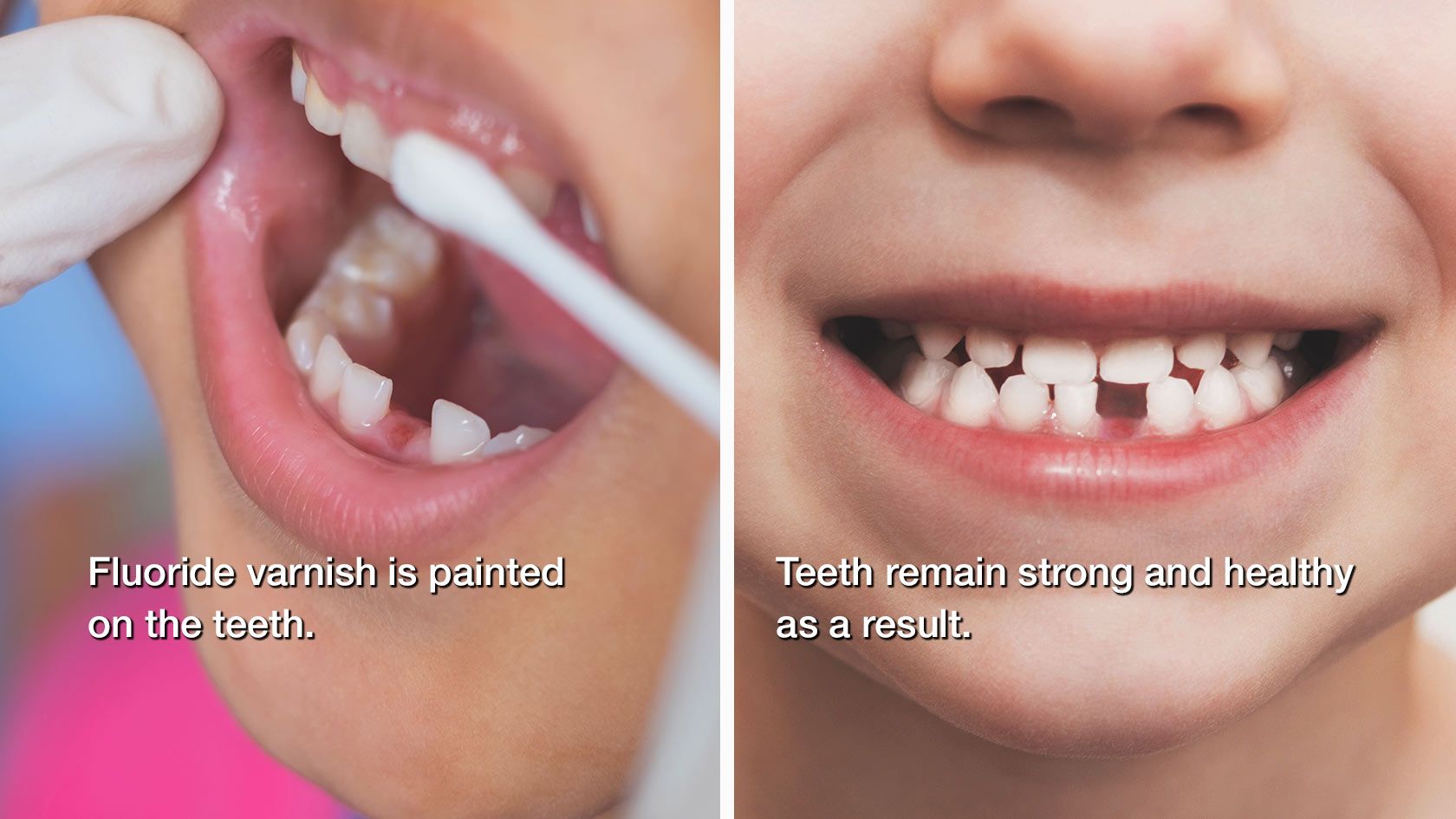 Child with missing teeth smiling as fluoride is applied to their teeth