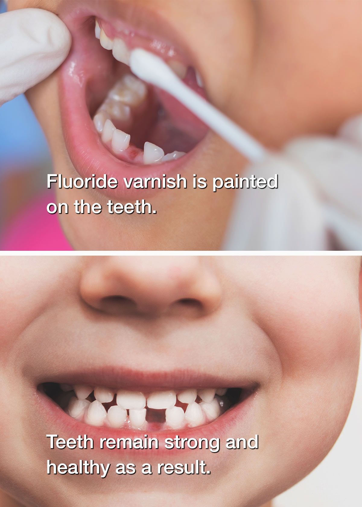 Child with missing teeth smiling as fluoride is applied to their teeth
