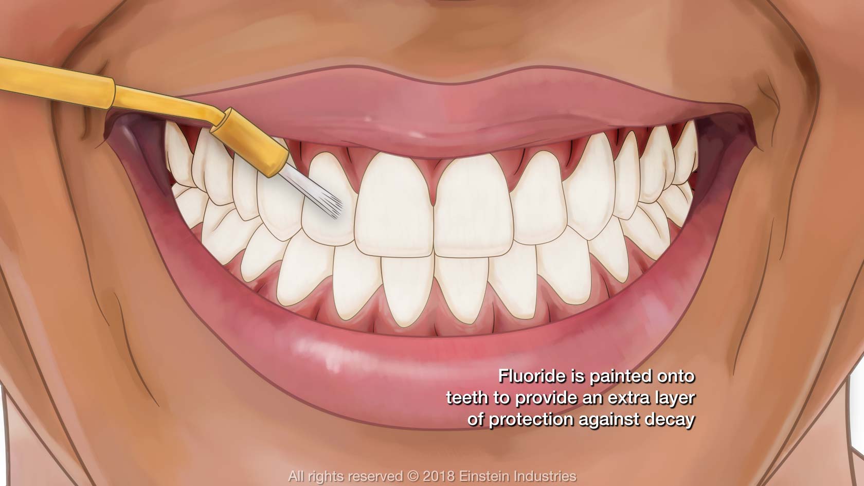 Illustration of fluoride gel as it is applied to smile